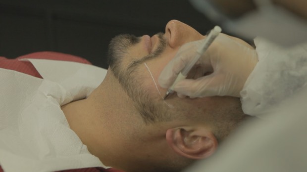 Micropigmentação sendo aplicada no preenchimento de barba